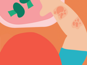 Food allergies and intolerances in children. Signs, symptoms and diagnosis